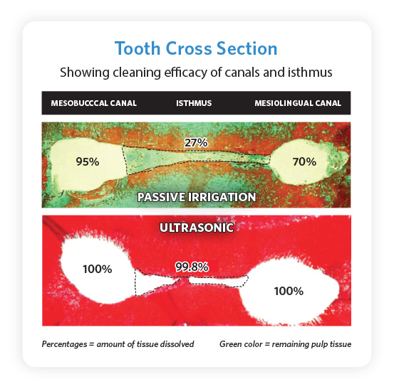 EndoUltra Tooth Cross Section