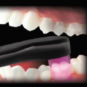 PinkWave™ QuadWave™ LED Curing Light – Vista Apex